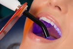 Zoom Tooth Whitening