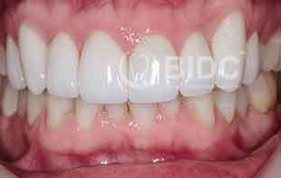 Prosthodontic Dentistry