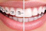 Stb braces Invisible Braces by STb™ Light Lingual